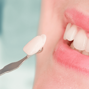 Dental Veneers Pros and Cons