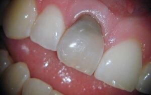 How Long Can a Tooth Infection Go Untreated