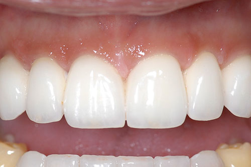 Tips For Keeping Your Teeth White
