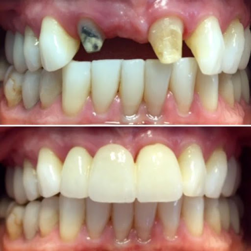 Dental Bridge Front Teeth Before & After 