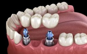 Implant-supported Dental Bridge