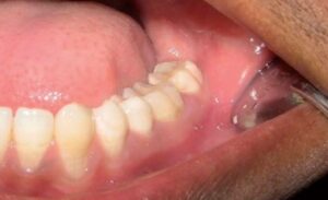 Does Coronavirus Affect Teeth And Gums