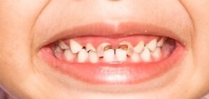 Dental Issues Among Children and Adolescents