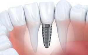 are dental implants safe