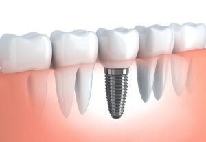 Confused by Tooth Implant Pricing