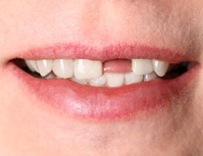 Confused by Tooth Implant Pricing