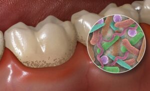 How Long Can a Tooth Infection Go Untreated