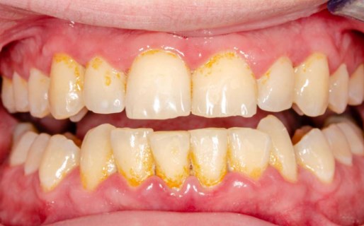 How To Remove Tartar From Teeth Without Seeing a Dentist