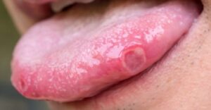 How To Cure Mouth Ulcers Quickly and Naturally