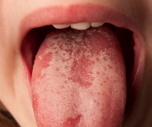 Bumps on the Back of My Tongue