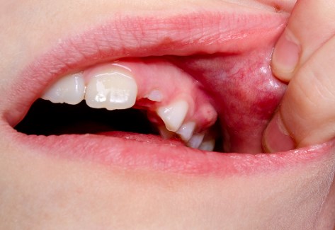 Tooth Abscess Nightmare: 5 Terrifying Stages You Need to Know