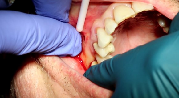 When a Dental Abscess Bursts: Your Essential Guide to Handling the Situation