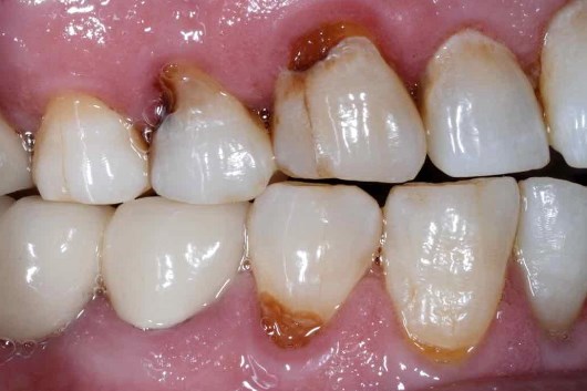 How Rotten Teeth Can Wreak Havoc on Your Whole Body!