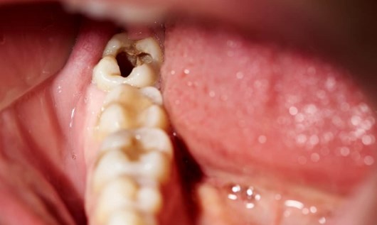 How Long Until a Tooth Infection Kills You