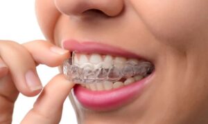 Beautiful Smile with Invisalign