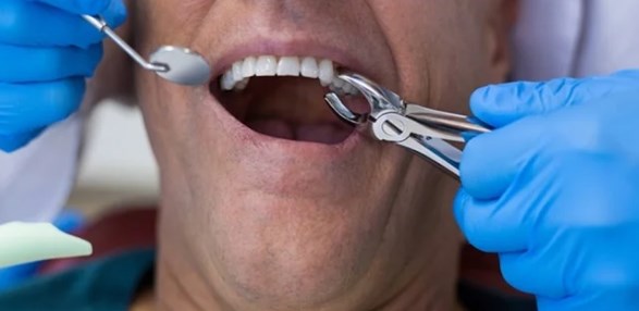 Navigating Post Tooth-Extraction Care