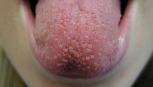 pimple on tongue