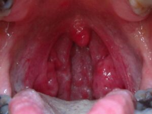 Cobblestone In The Throat 