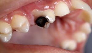 How Can I Make My Tooth Extraction Heal Faster?