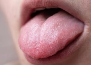 Liars Bump on Tongue