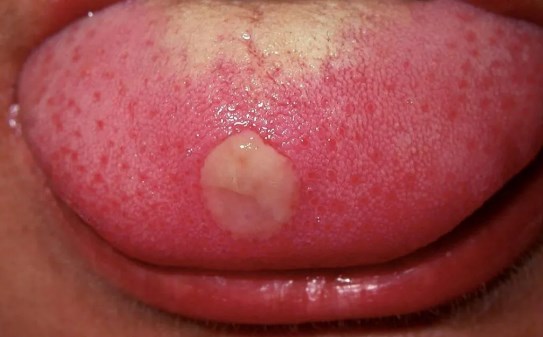 Understanding the Causes and Treatment Options for Pimple on Tongue