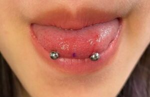 Infection From Tongue Piercing