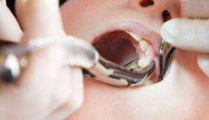 How Can I Make My Tooth Extraction Heal Faster?