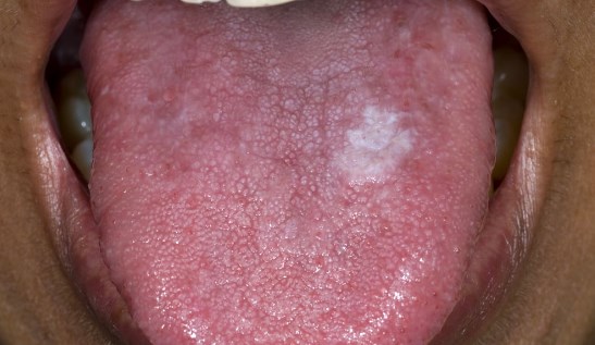 Understanding the Causes and Treatment of White Bump On Tongue
