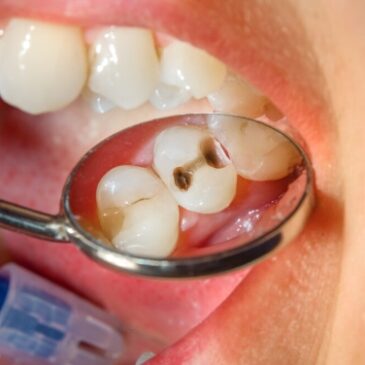 Causes and Solutions For Recurrent Cavities in Adults