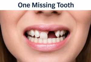 Partial Denture for One Missing Tooth