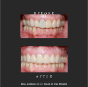 before and after