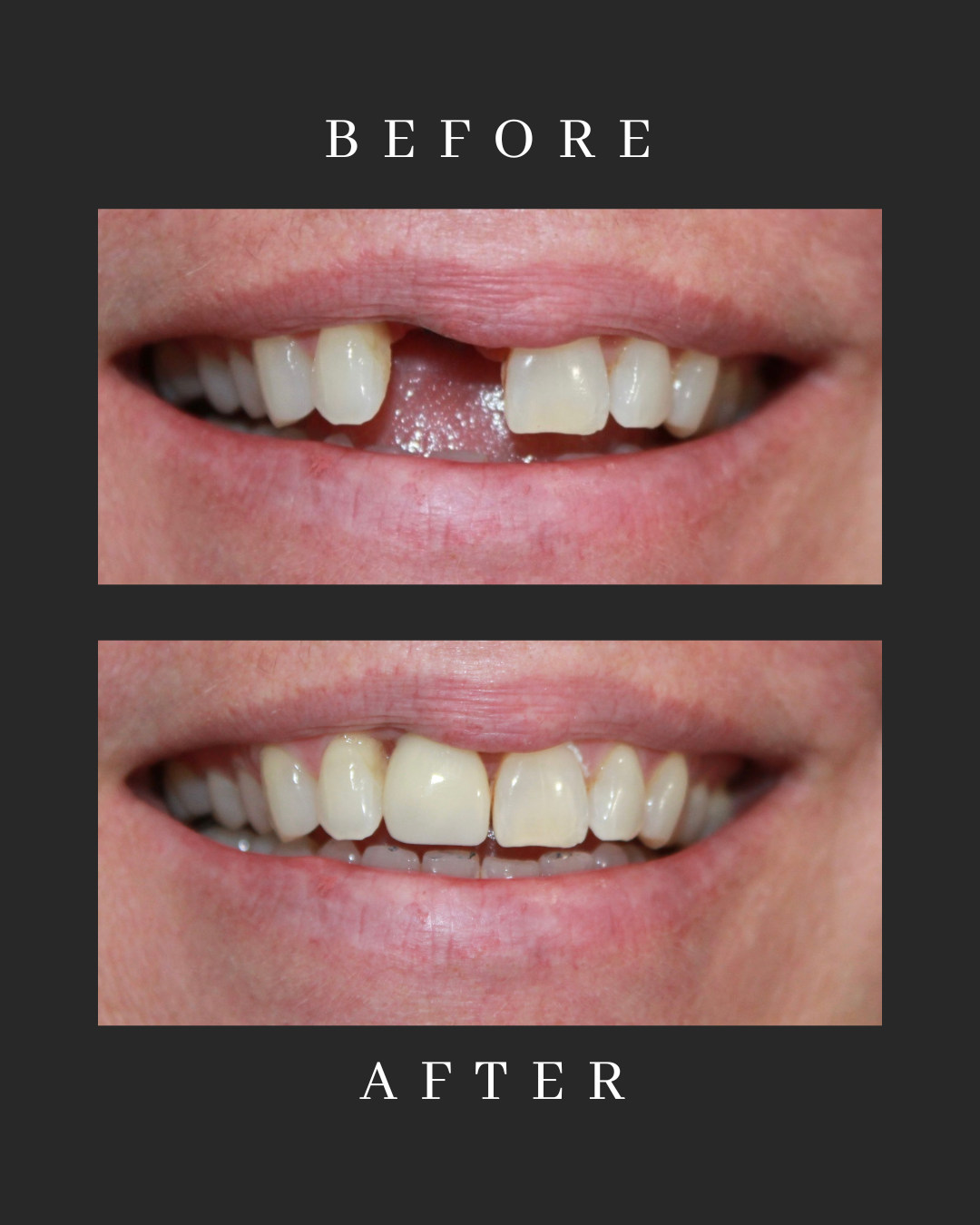 Dental Implants