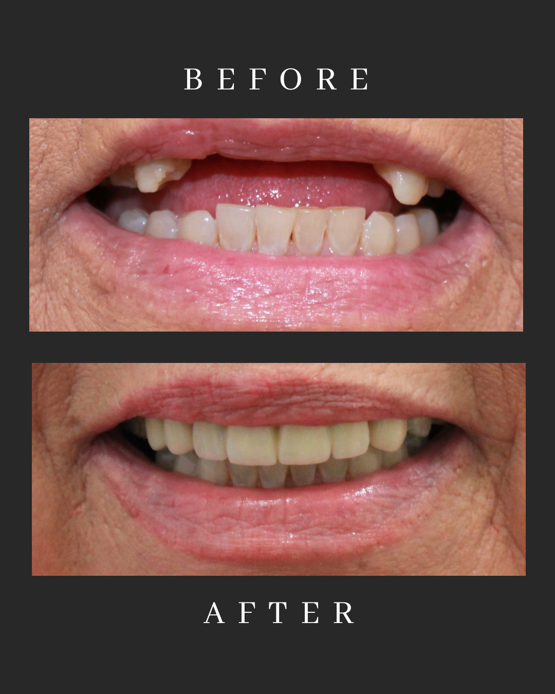 Dental Implants