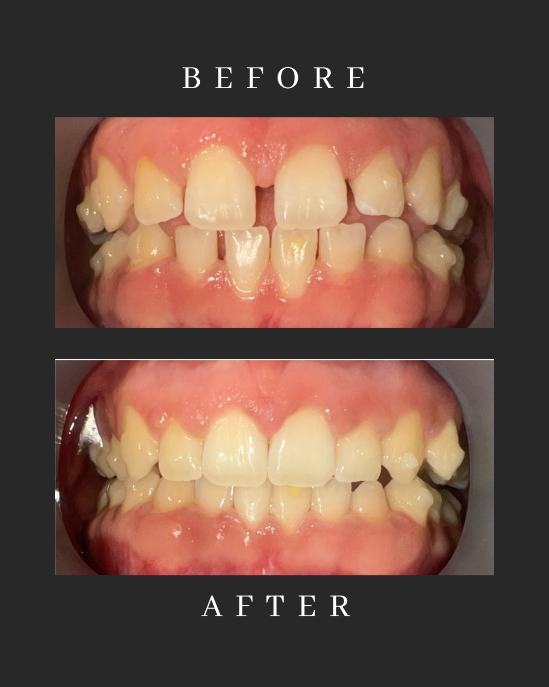 Invisalign Case 1