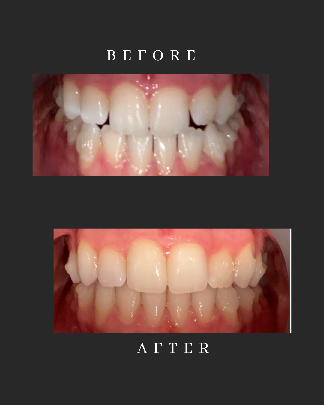 Invisalign Case 2