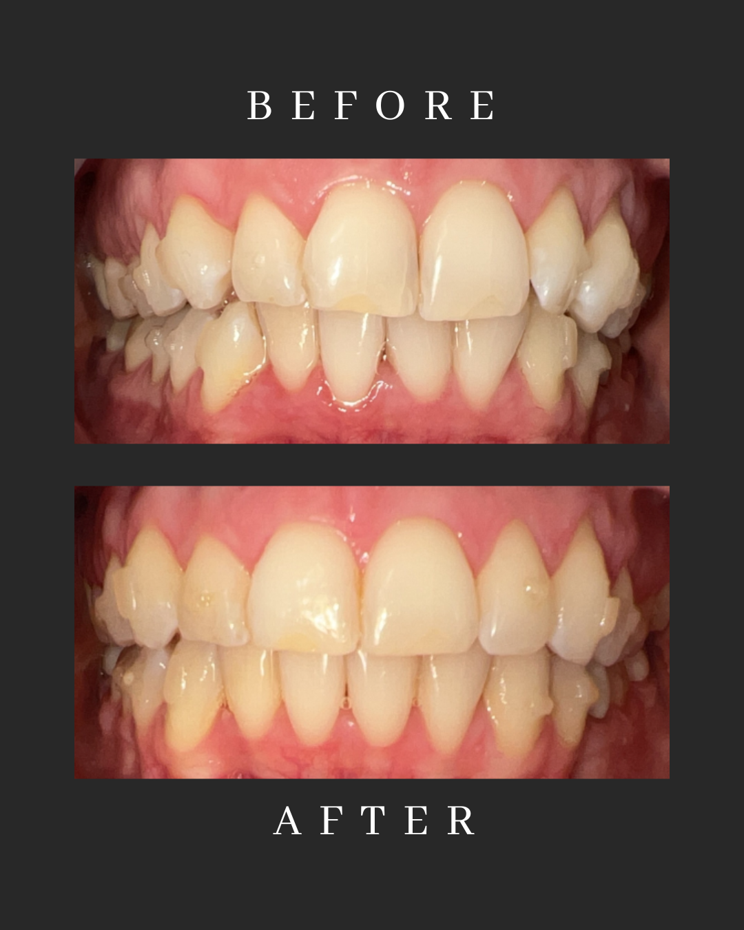 Invisalign Case 3