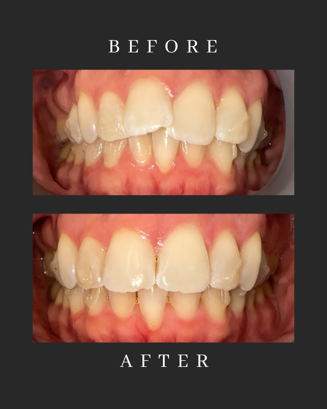 Invisalign Case 4
