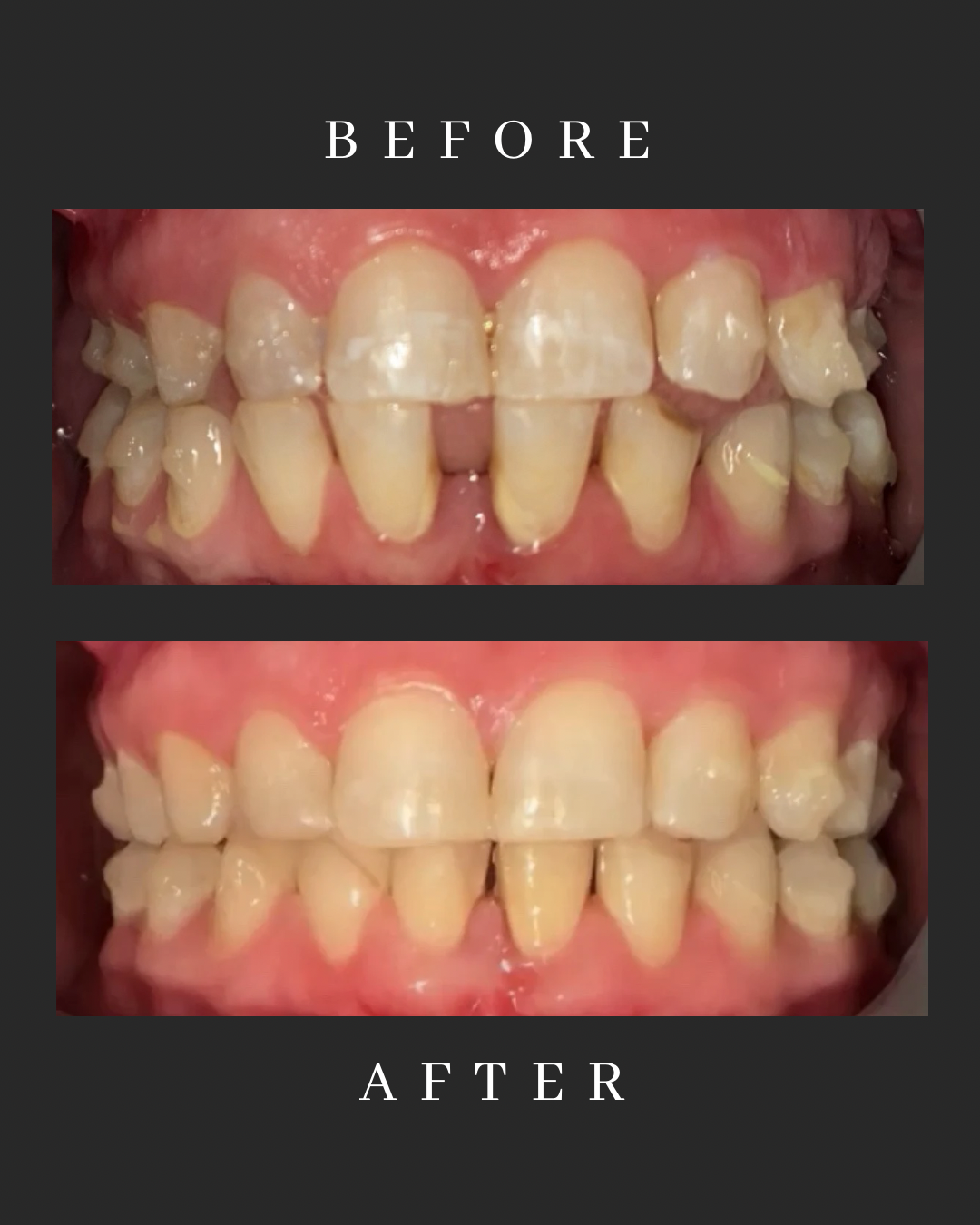 Invisalign Case 5