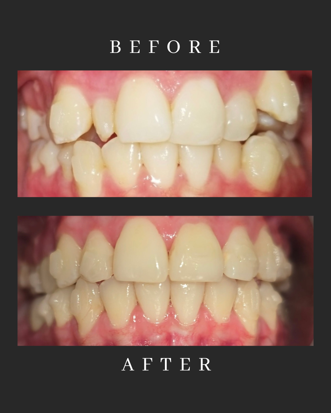 Invisalign Case 6