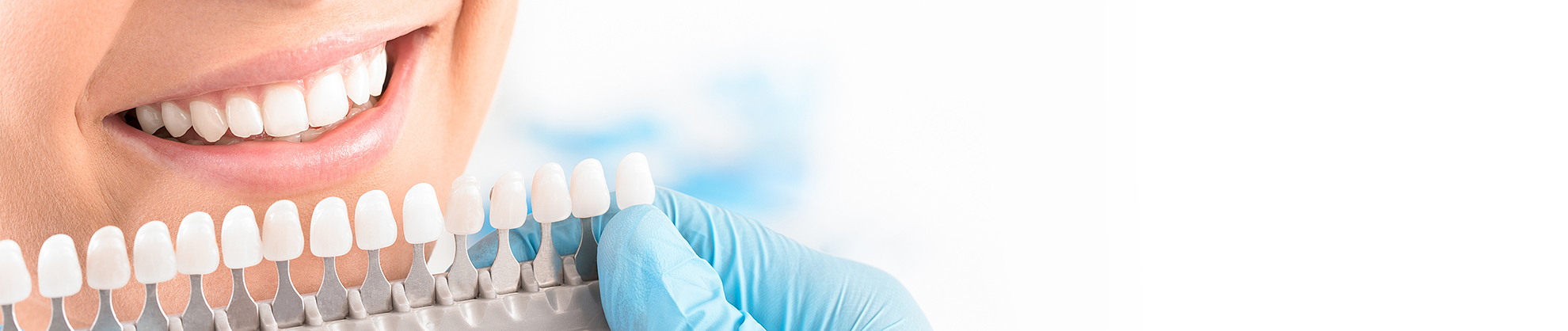 Dental Veneers in Kyle