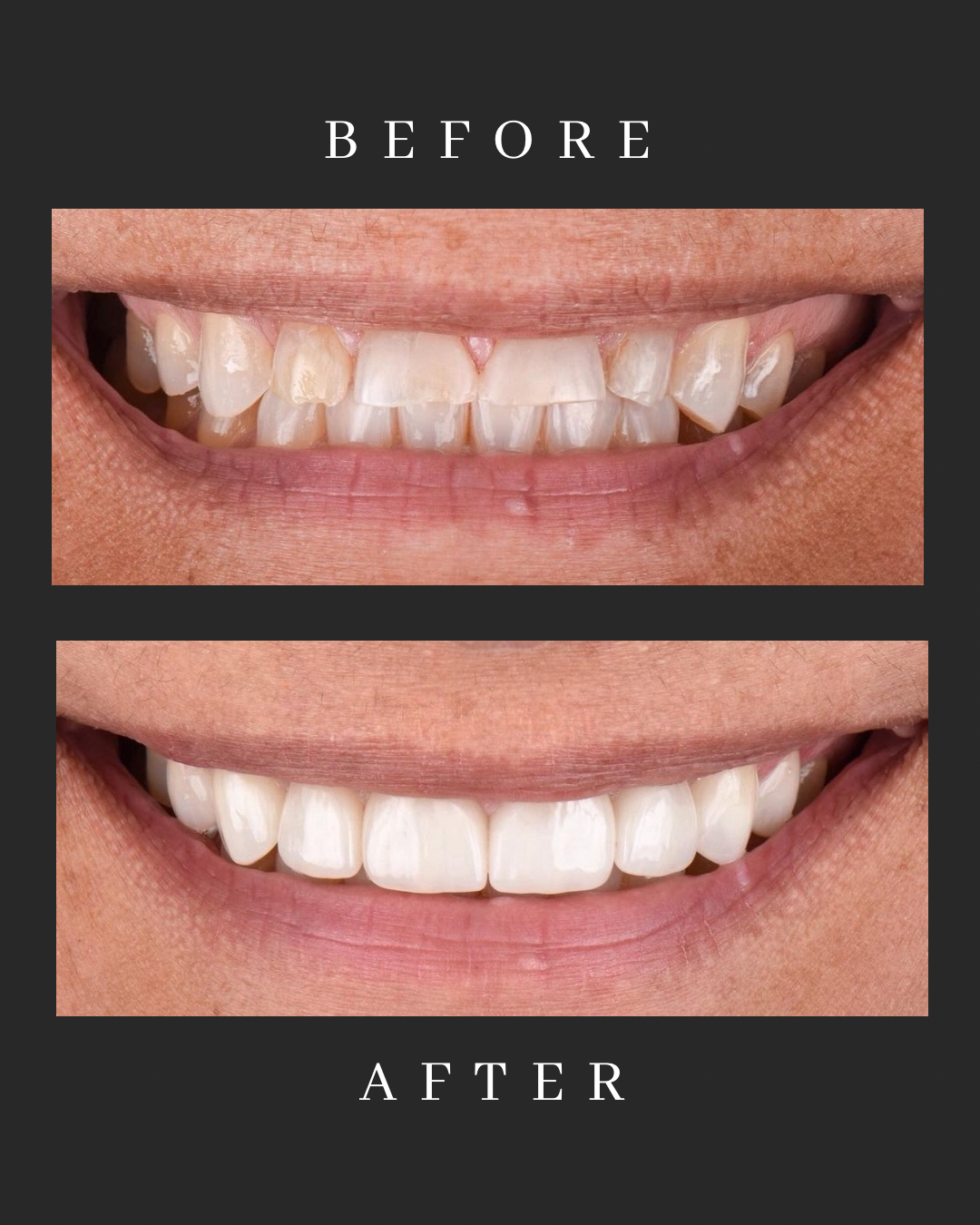 Veneers Case 1