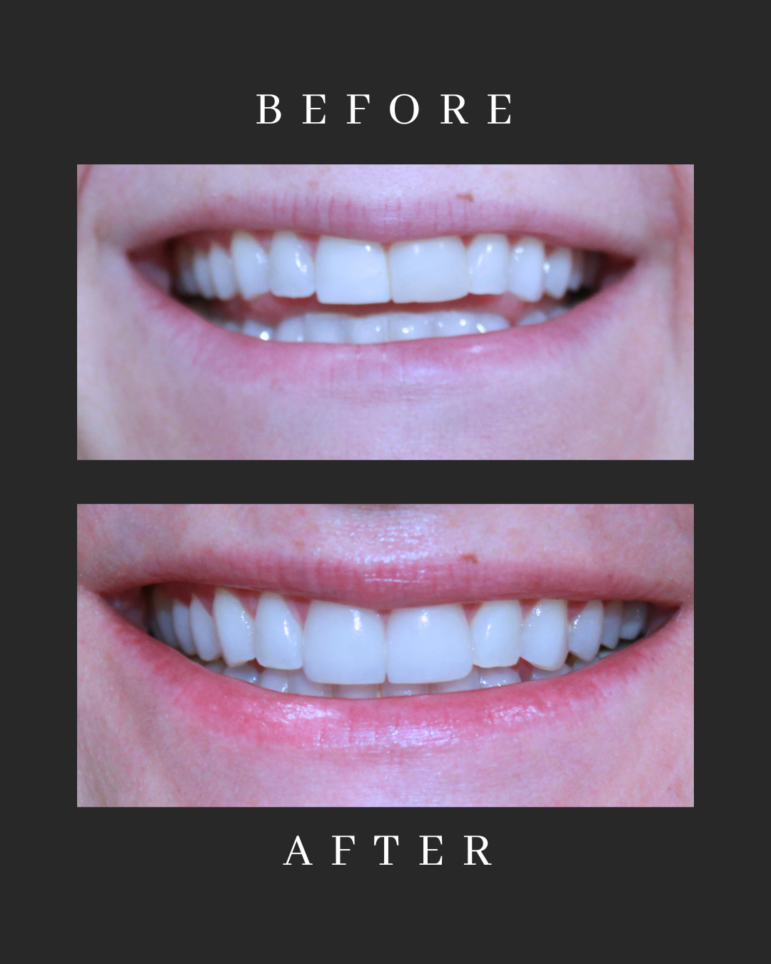 Veneers Case 2