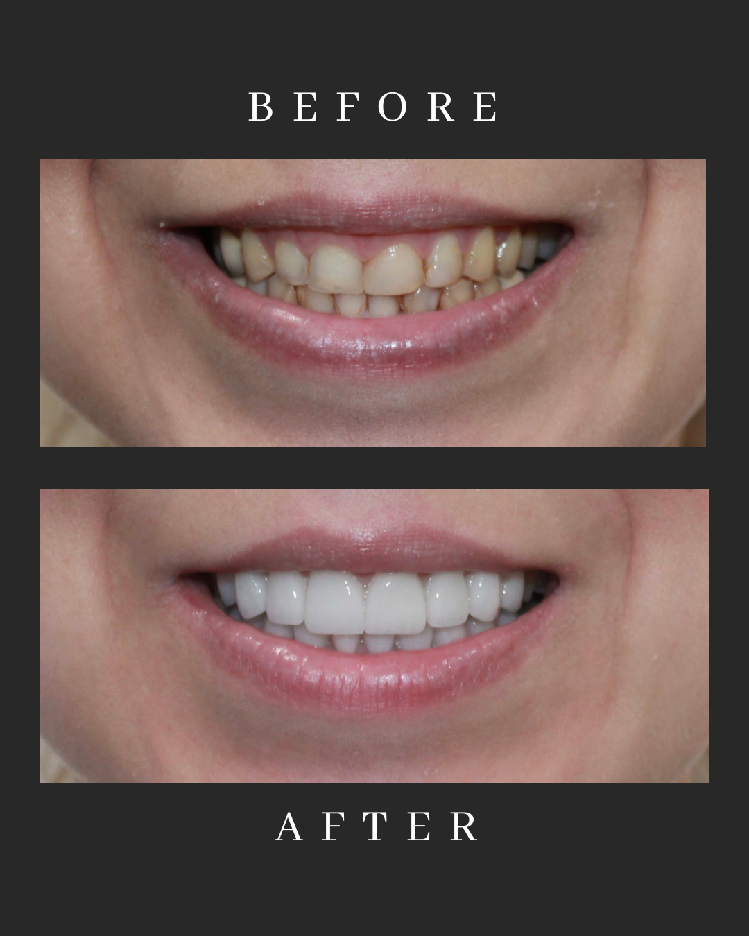 Veneers Case 3