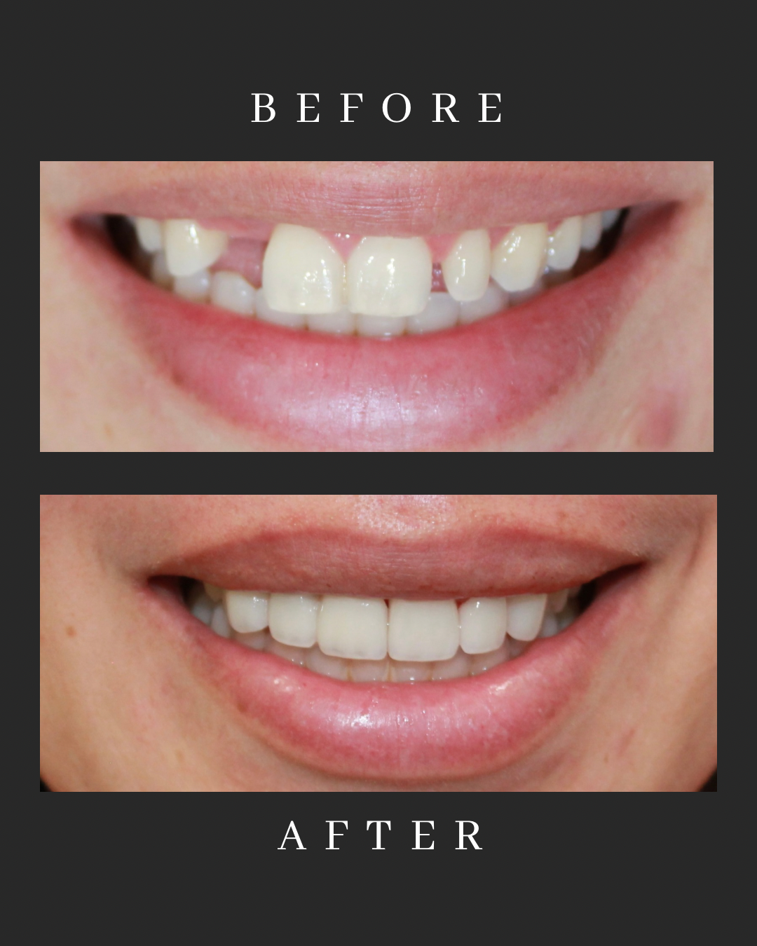 Veneers Case 4