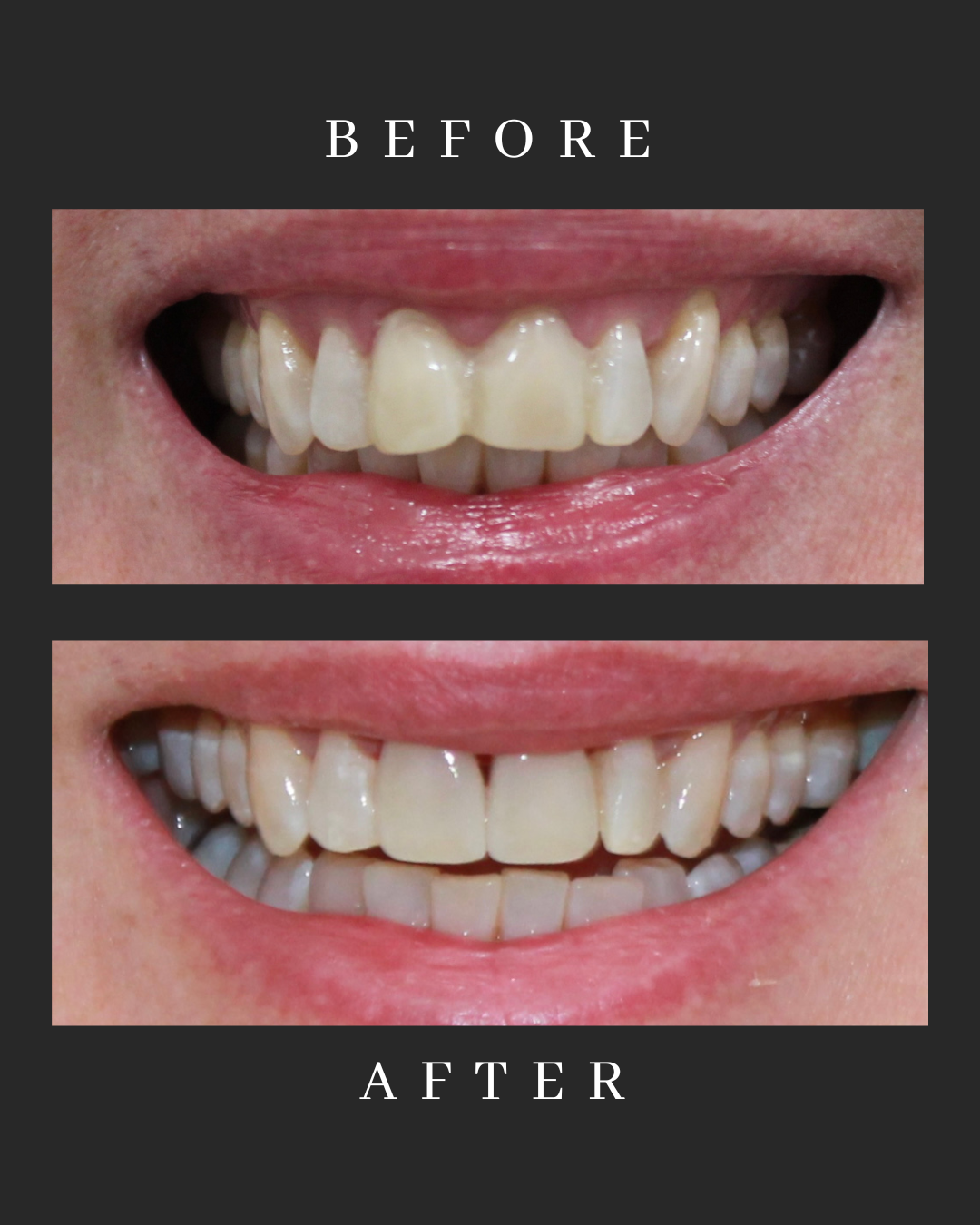 Veneers Case 5