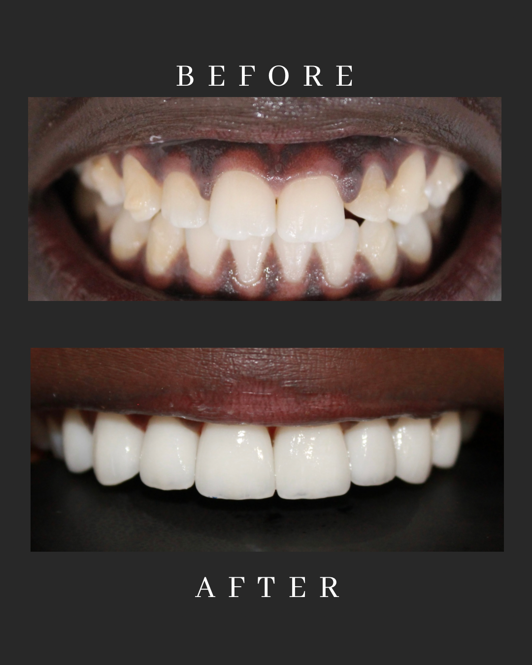 Veneers Case 6