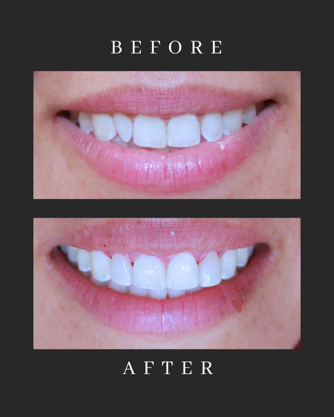 Veneers Case 7