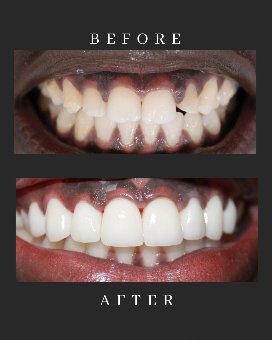 Veneers Case 8