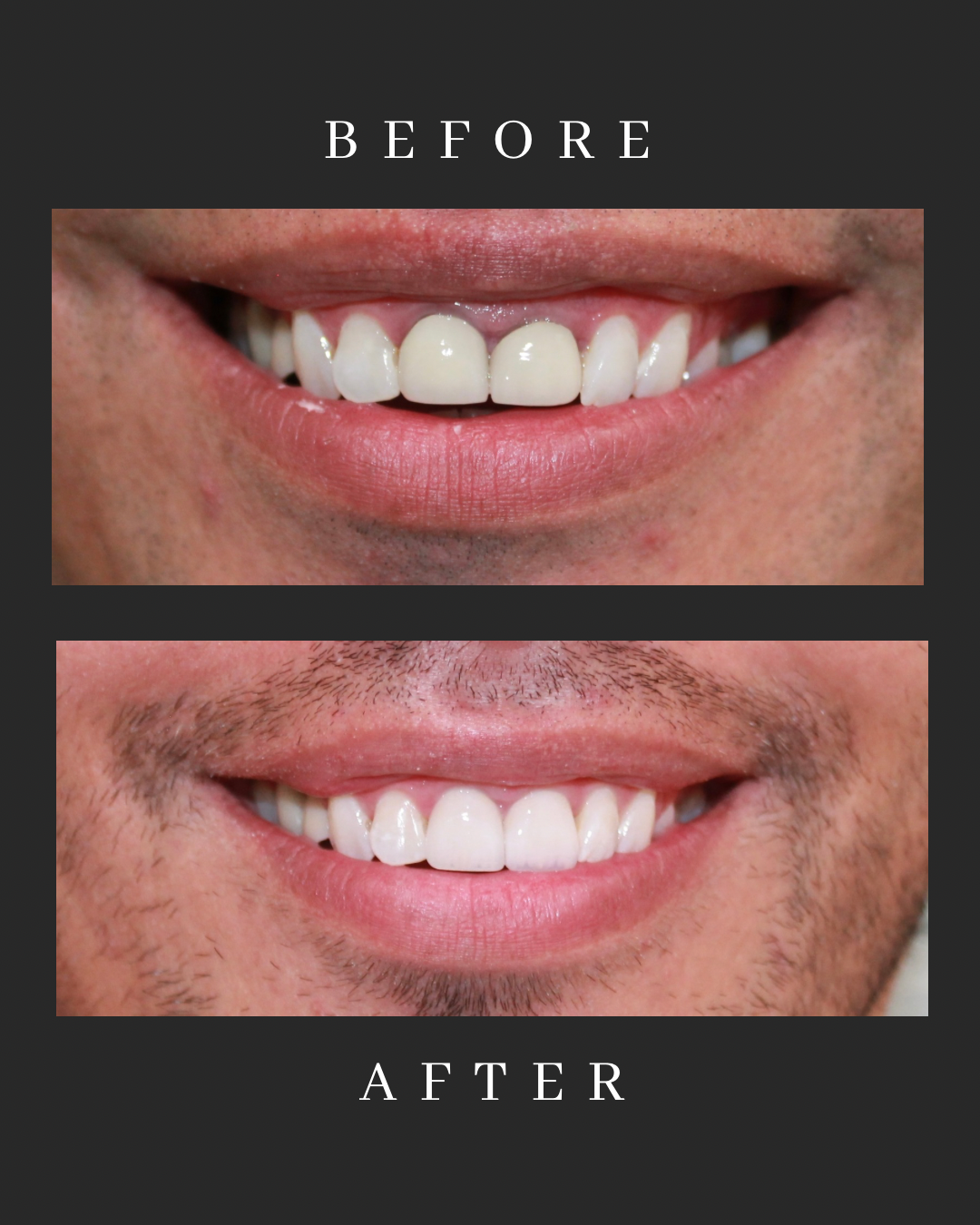 Veneers Case 9